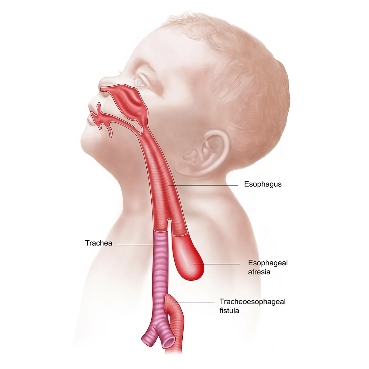 Diagram of a tracheoesophageal fistula