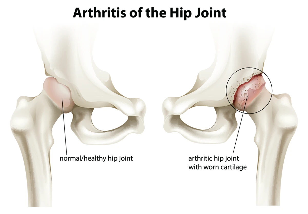 The image shows the difference between a healthy hip joint and one with hip osteoarthritis.