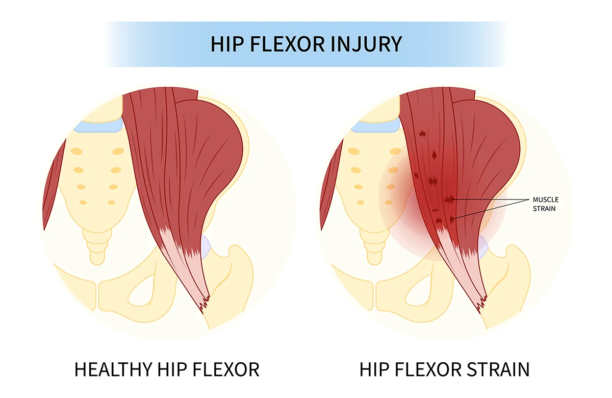 The image shows the difference between a healthy hip flexor muscle and a hip flexor injury.