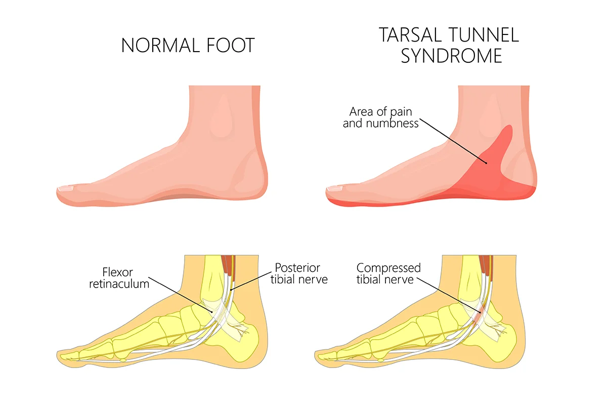 A foot with tarsal tunnel syndrome is compared to a healthy, normal foot – the compressed posterior tibial nerve creates an area of pain and numbness found in tarsal tunnel syndrome.