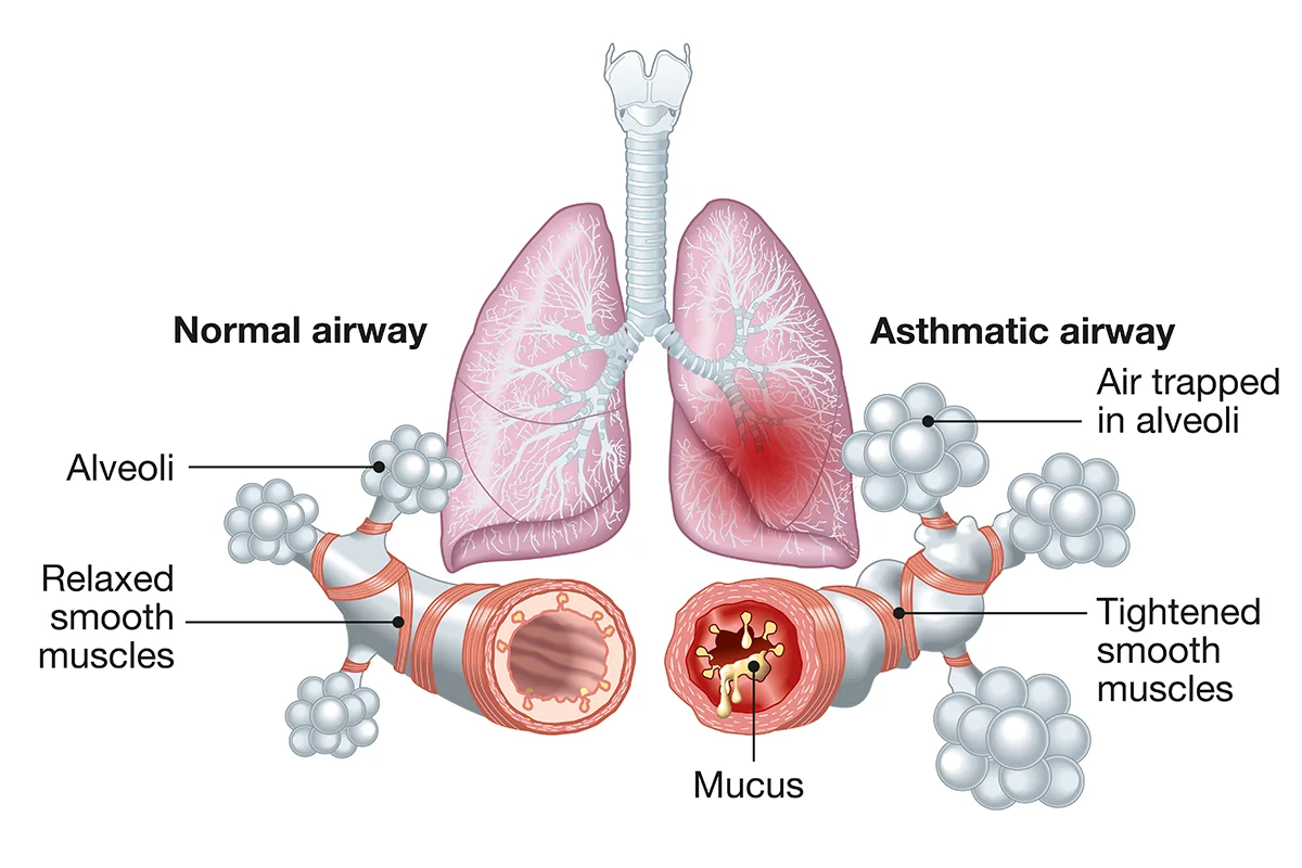 Image shows an anatomical breakdown of a normal airway versus an asthmatic airway.
