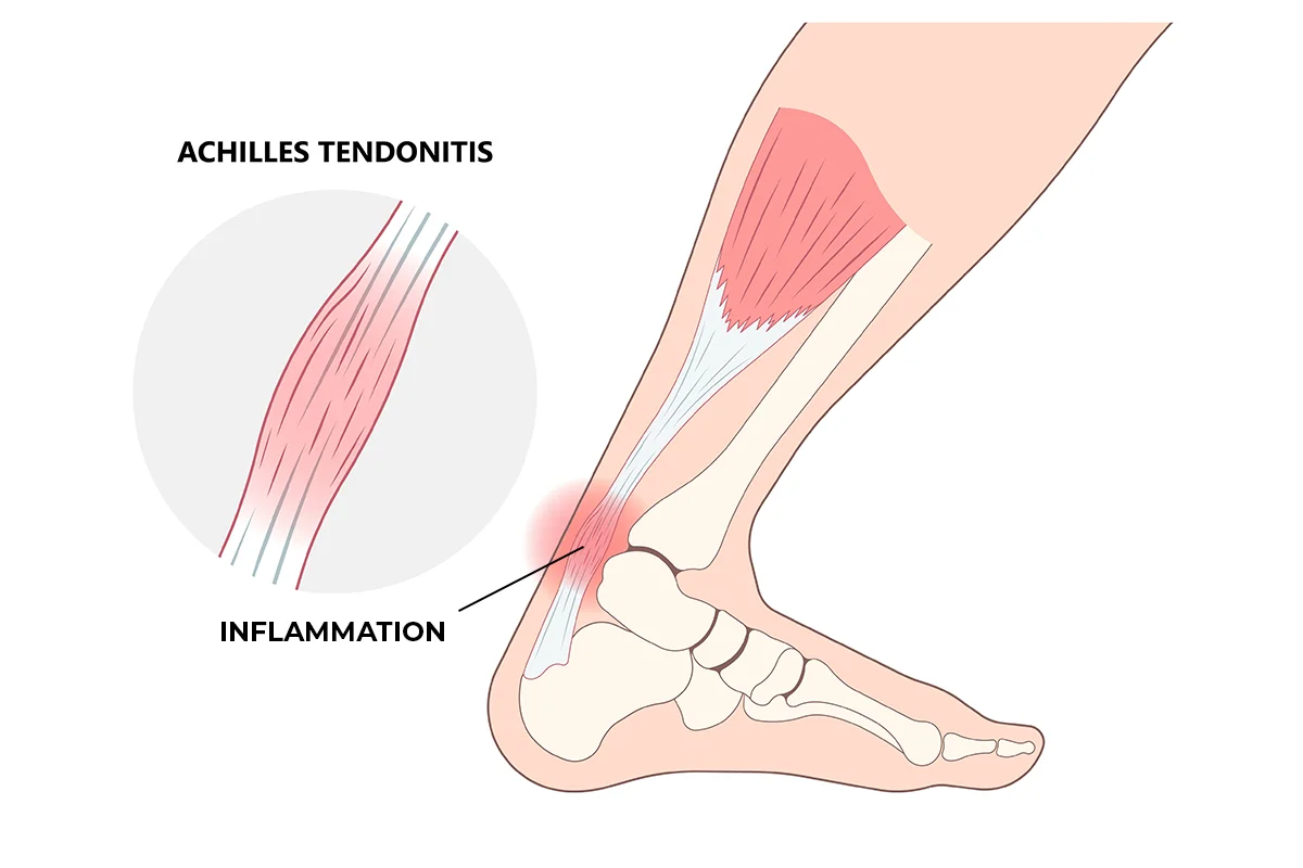 achilles tendonitis