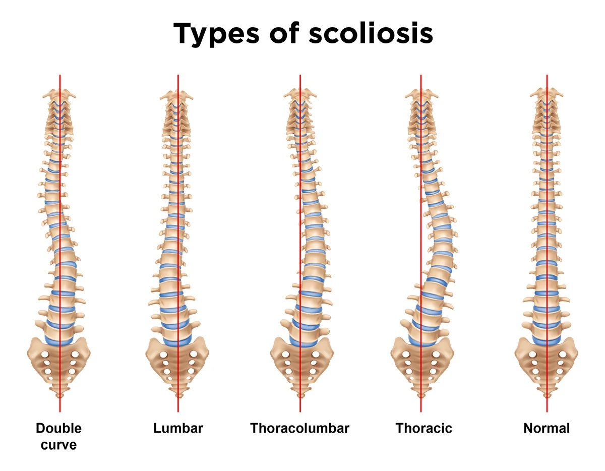 The image shows four different categories of scoliosis, including thoracic, lumbar, thoracolumbar and a double curve.