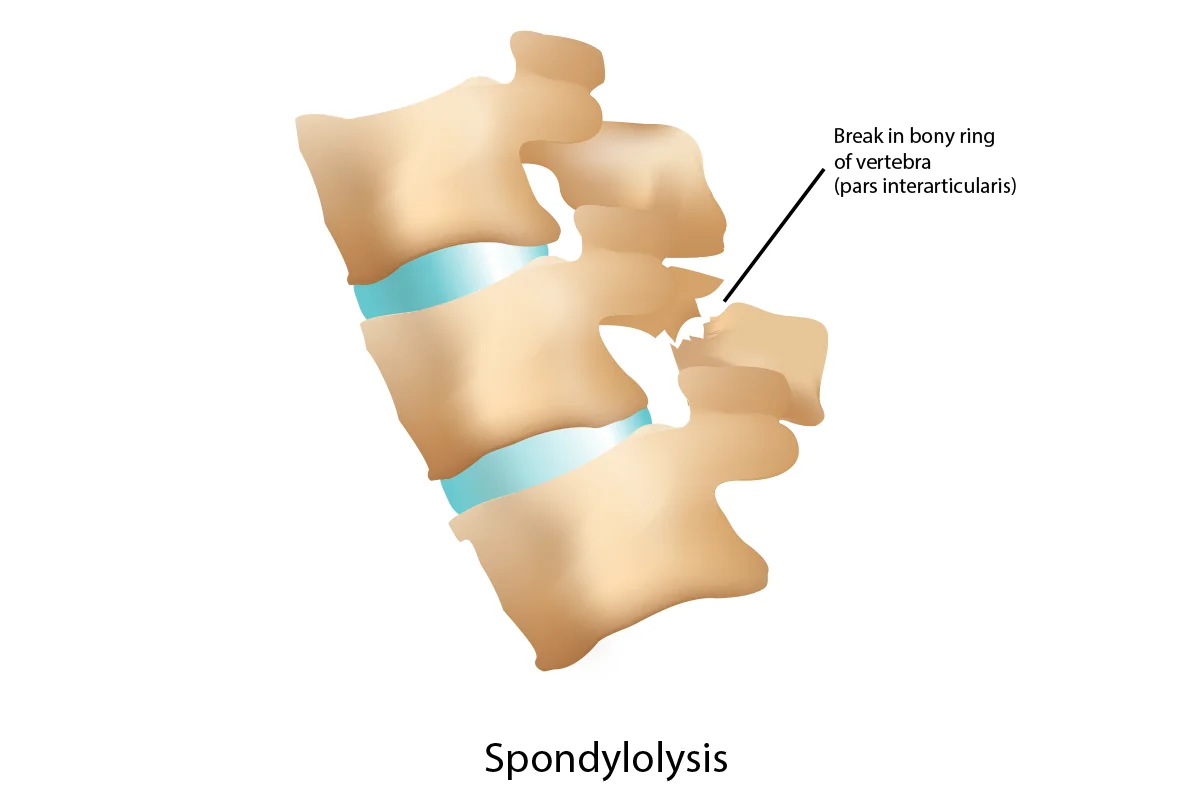 Side view of the spine shows the pars interarticularis – the part of the vertebra that’s fractured in spondylolysis.