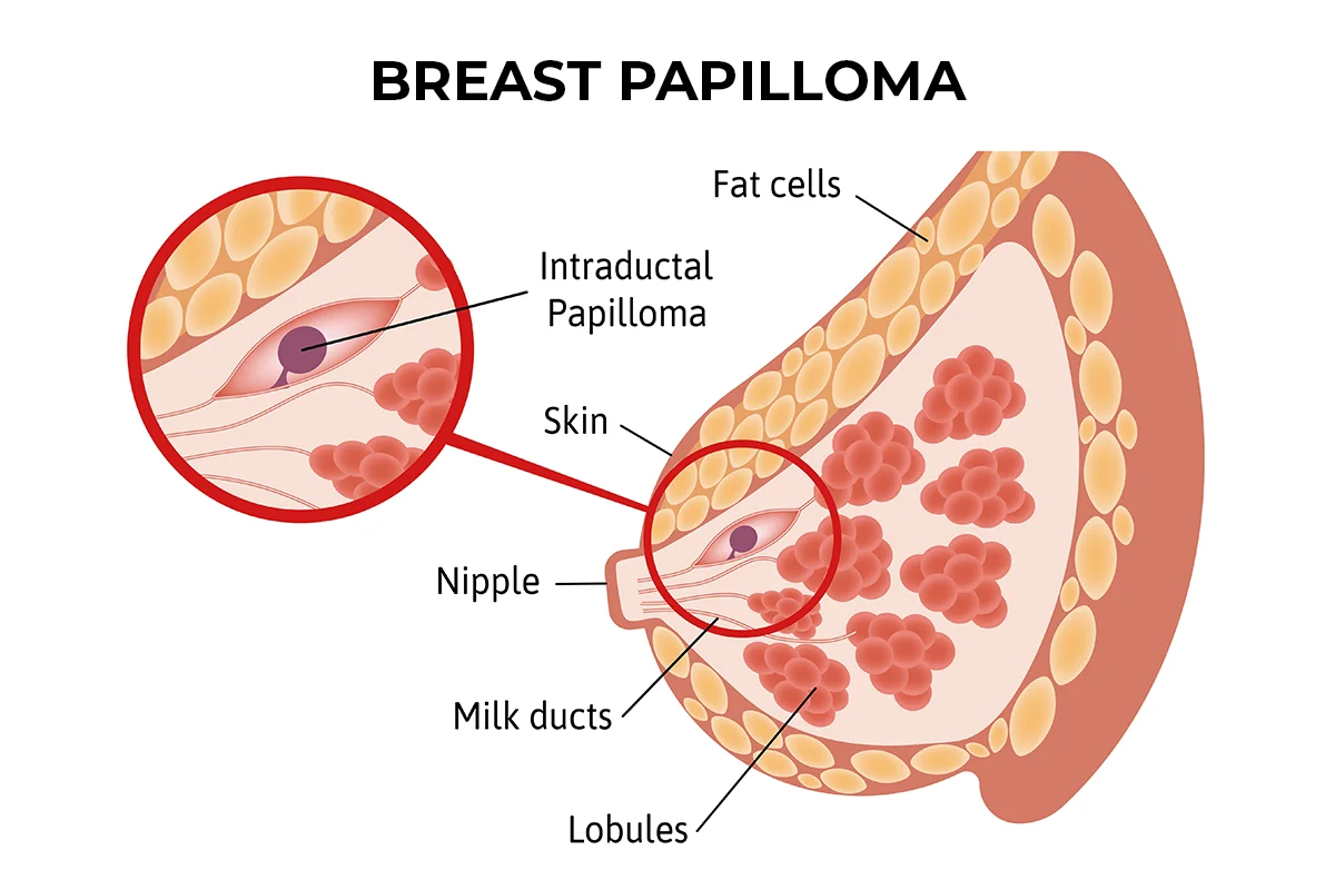 The image shows a breast papilloma lodged in the milk duct of the breast.