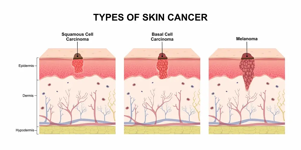 Image shows three types of skin cancer and how they form in the outer layer of skin.