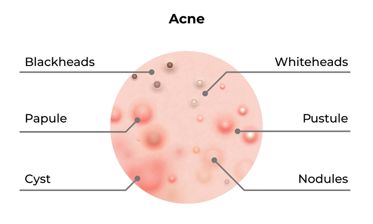 Image shows different types of acne and their appearance, including whiteheads, blackheads, pustules, papules, cysts and nodules.