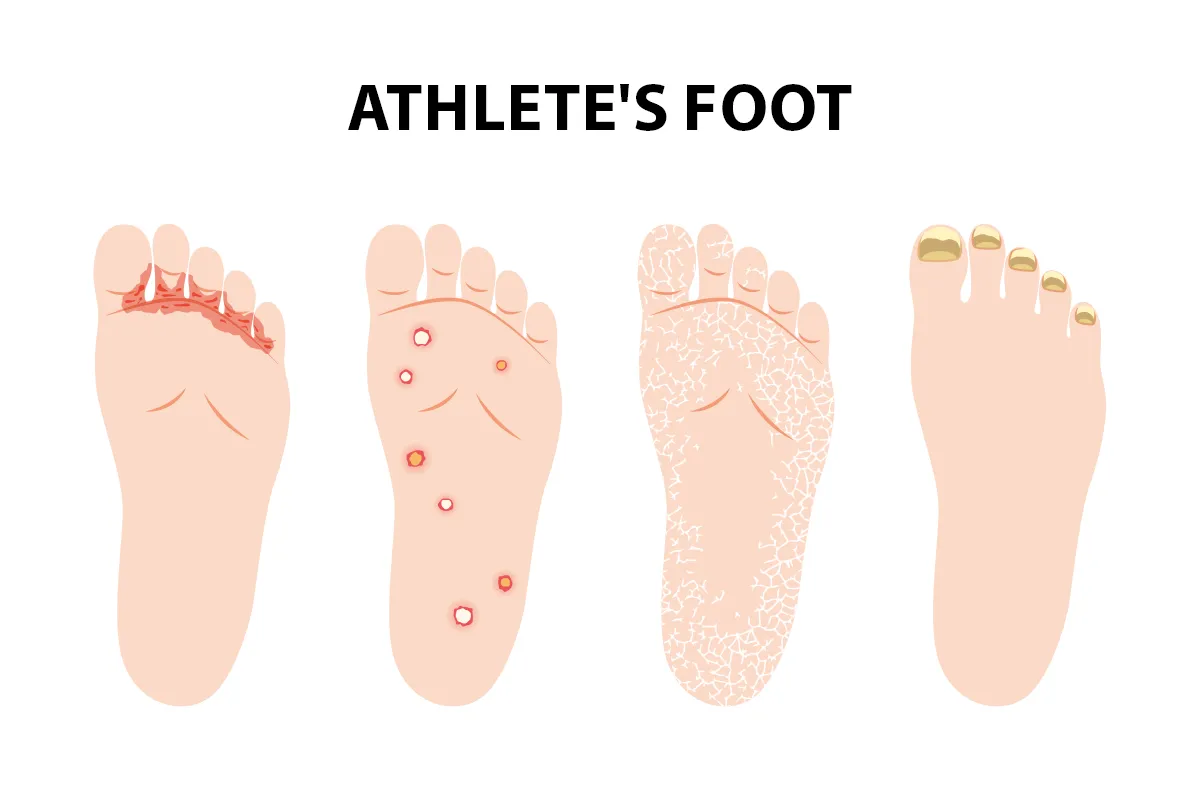 Athletes Foot Moderate Severe Case Athletes Foot Tinea Stockfoto Athletes Foot Moderate Severe Case Athletes Foot Tinea Stockfoto