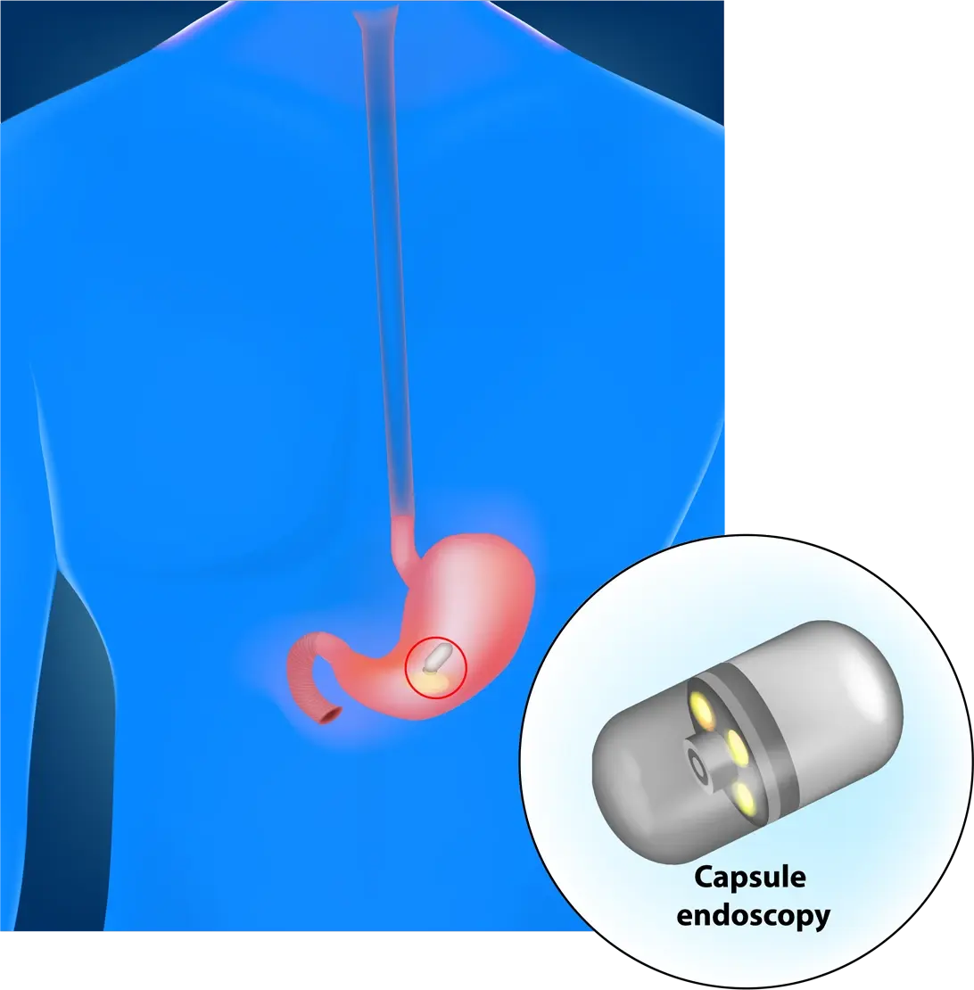 Image shows a capsule endoscopy.