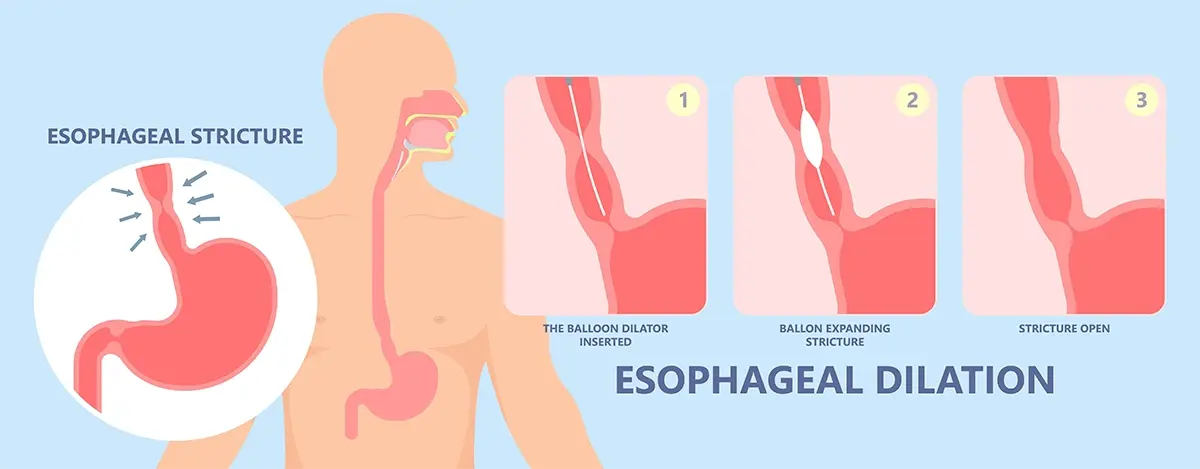 Diagram of esophageal stricture with balloon dilation
