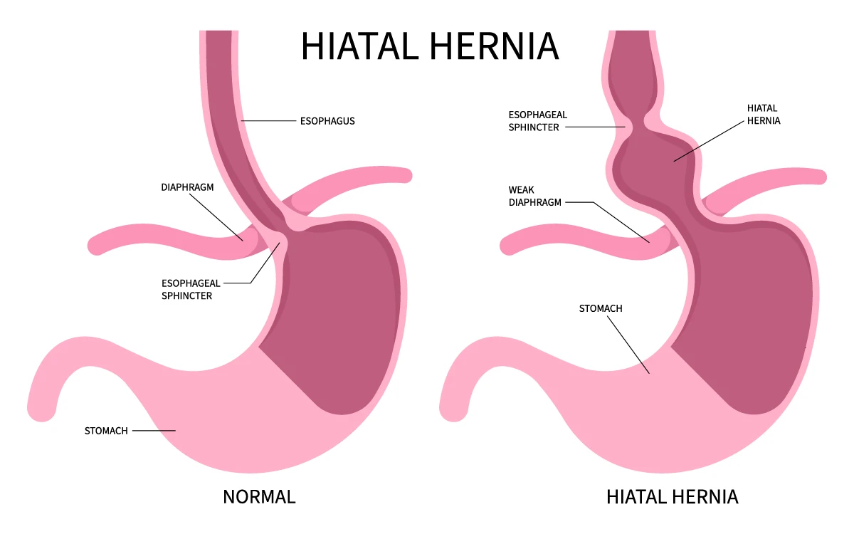Hernia Hiatal Hernia Symptoms Diagnosis And Treatment Beaufort Hernia Hiatal Hernia Symptoms Diagnosis And Treatment Beaufort