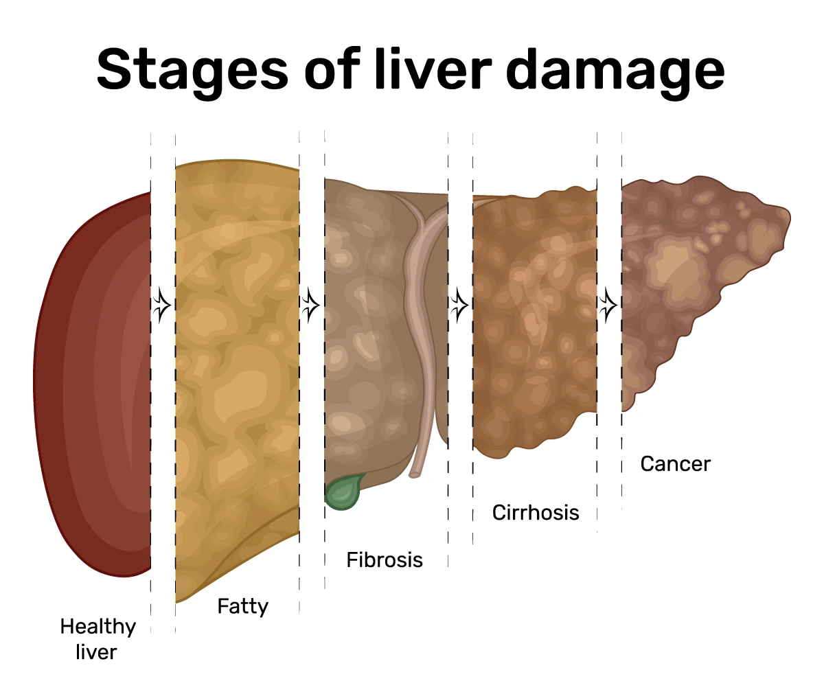 liver disease