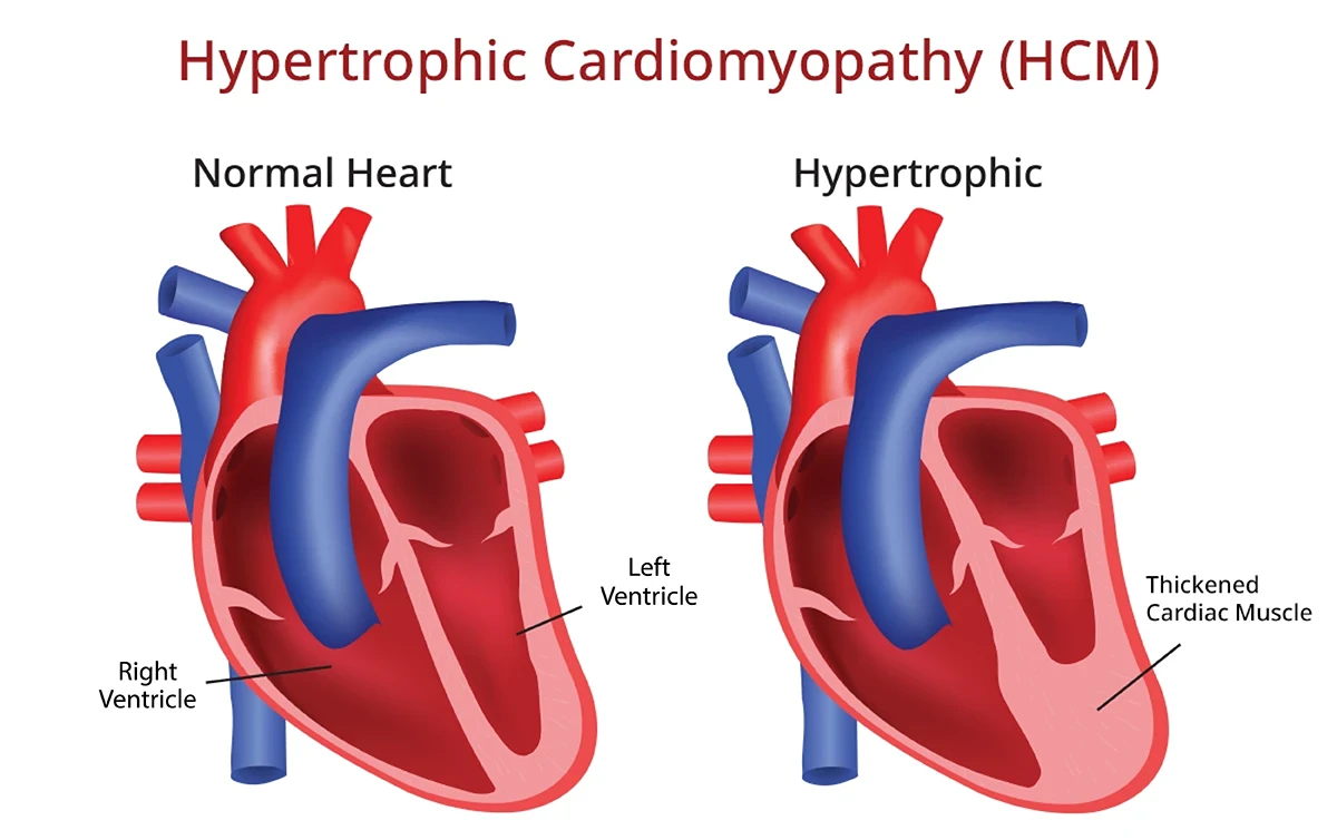 hypertrophic cardiomyopathy