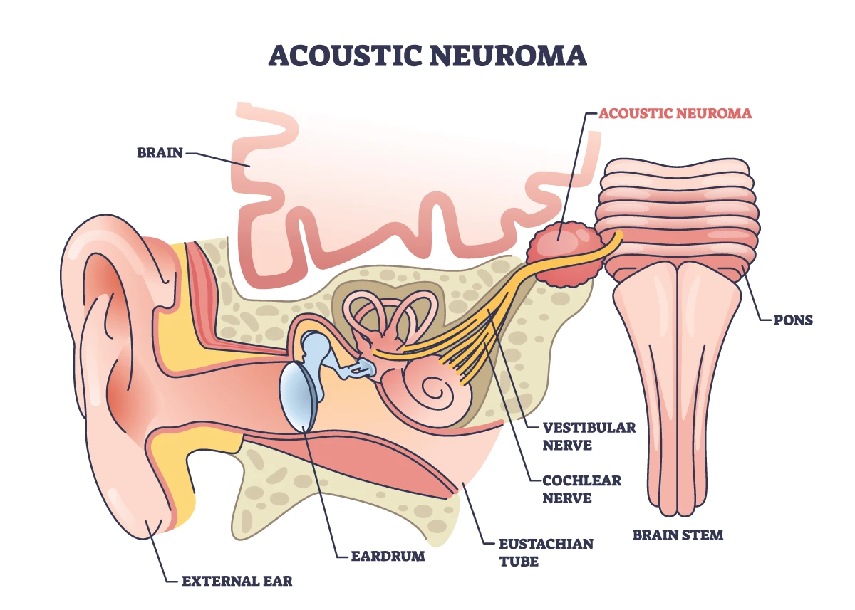 Image shows vestibular schwannoma tumor on the vestibular nerve