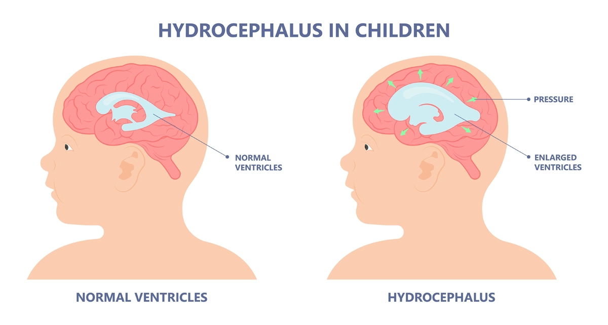Hydrocephalus Aurora Health Care Hydrocephalus Aurora Health Care