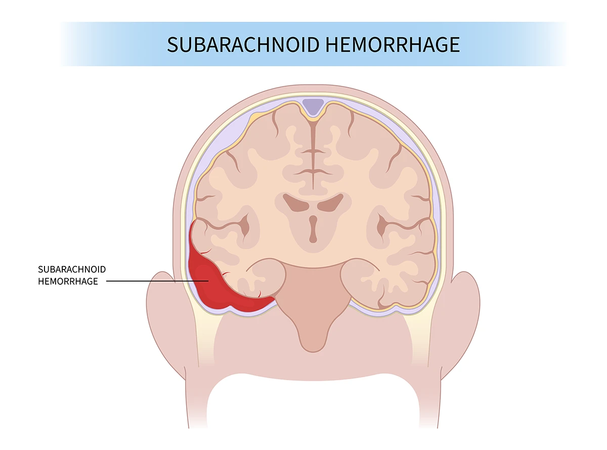 Image shows the location of a subarachnoid hemorrhage near the base of the brain