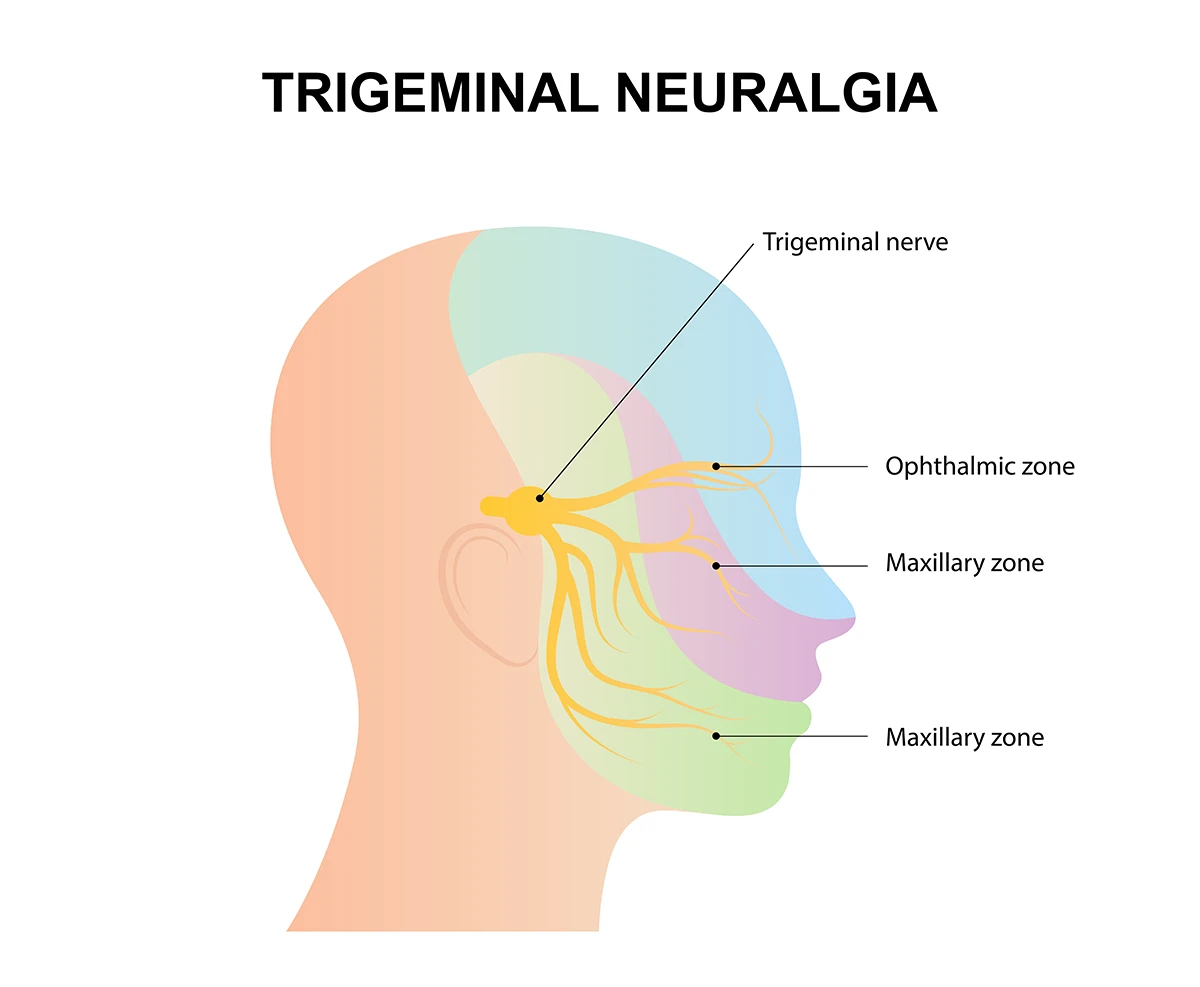 The image shows the three zones that are impacted by trigeminal neuralgia.
