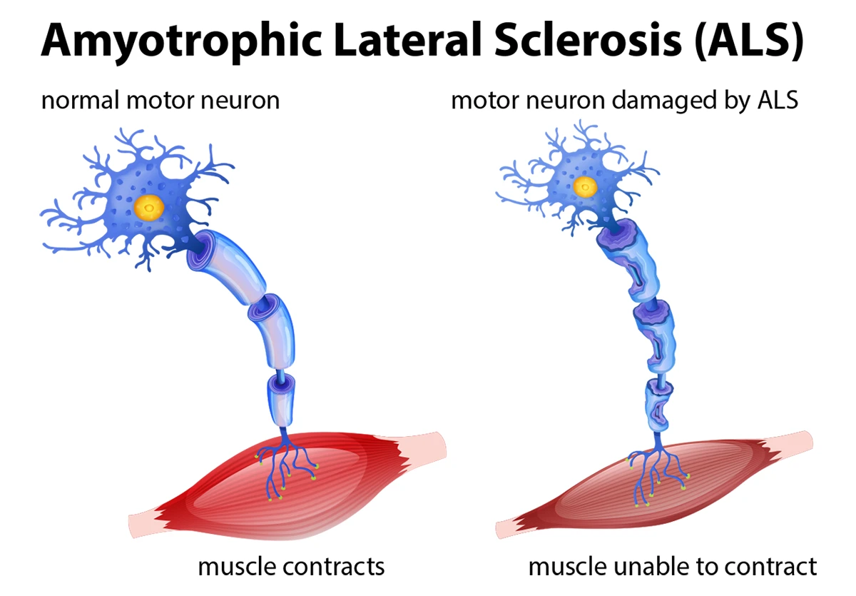 Image shows normal motor neuron and motor neuron damaged by ALS.