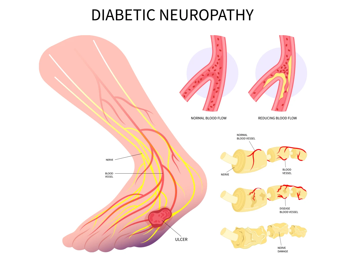 The image shows three ways diabetic neuropathy impacts your foot