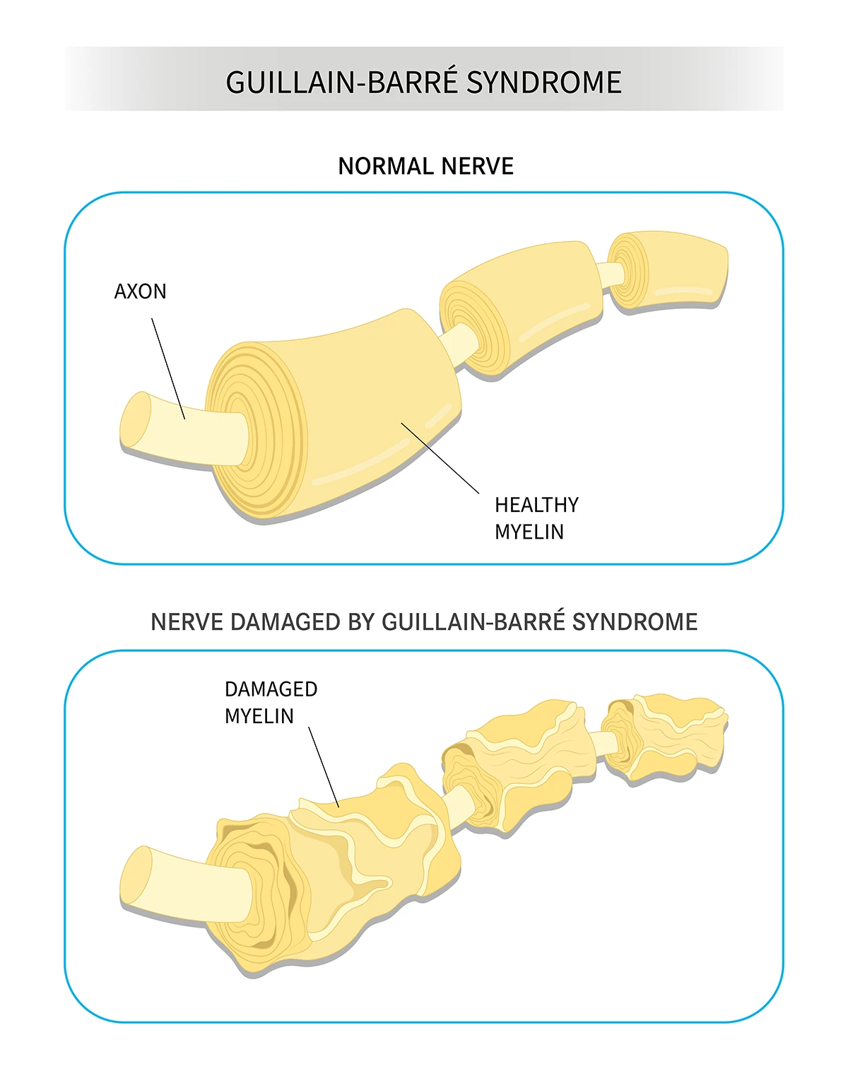 Image shows difference between a healthy nerve and a nerve with myelin sheath damaged by Guillain-Barre syndrome.