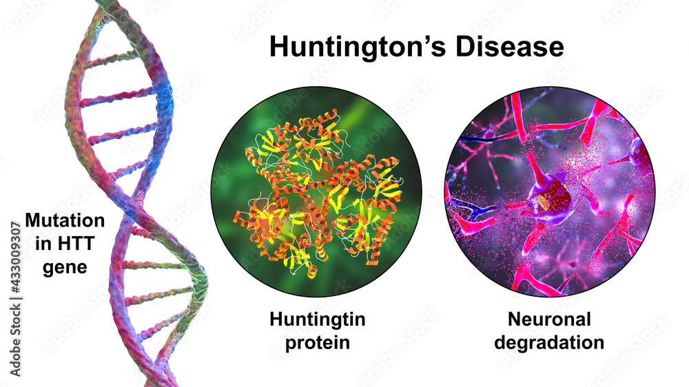 Image shows the mutation that causes Huntington's disease, the abnormal proteins caused by the mutation and the eventual damage to nerves in the brain.