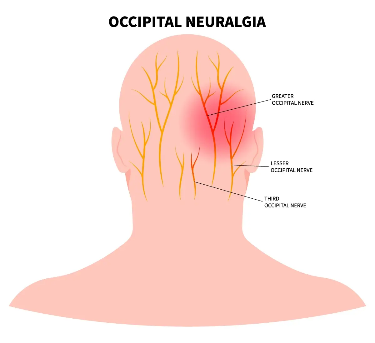 The image shows the area of the skull that an occipital neuralgia headache affects in the back of the head.