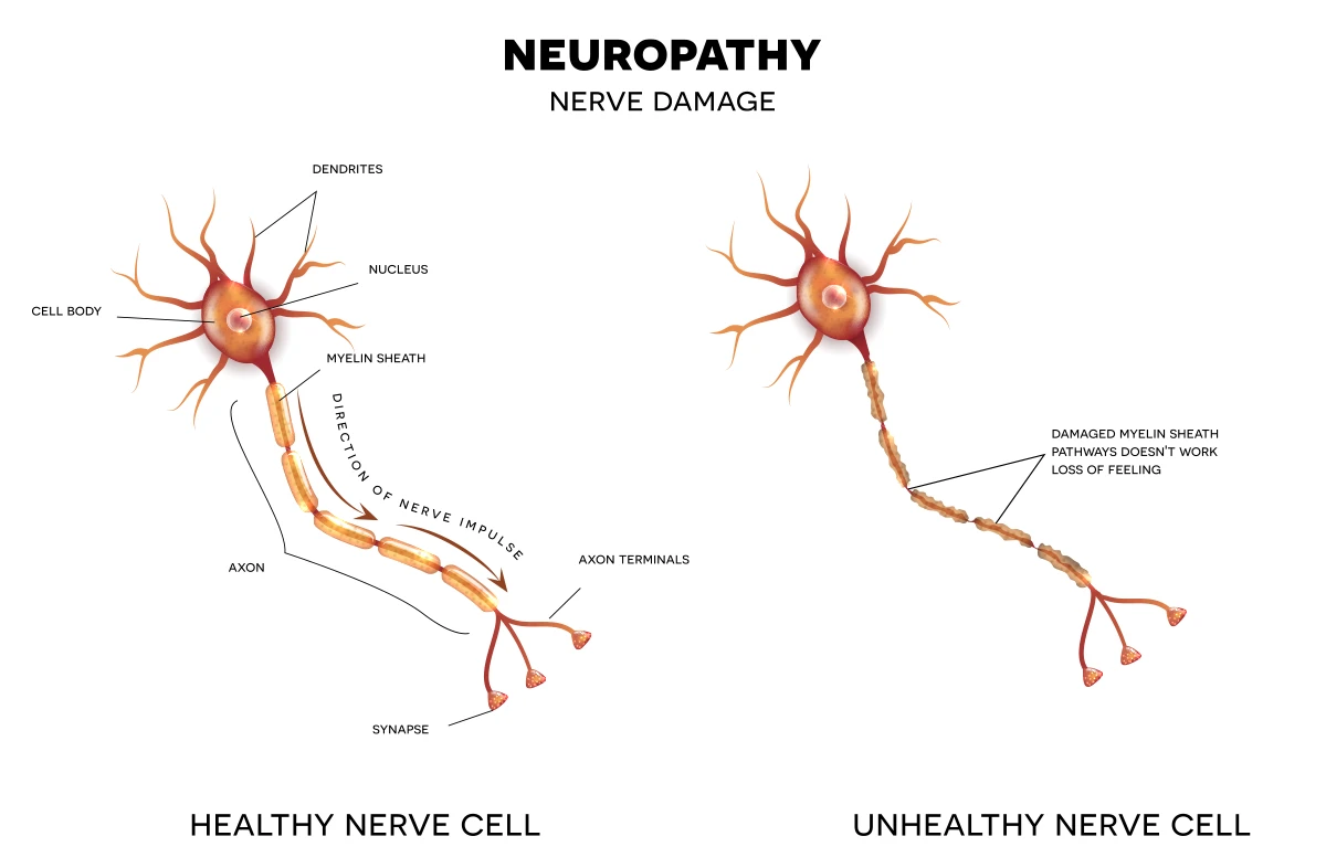 The image shows a comparison of a healthy nerve cell and one that is affected by neuropathy