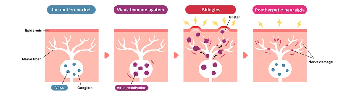 Image shows possible effects of the varicella zoster virus: initial chickenpox infection, dormant phase, shingles and postherpetic neuralgia.