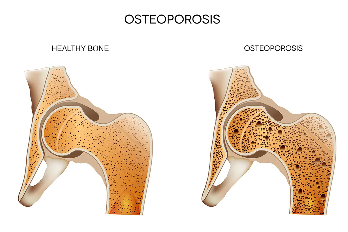 The image shows the difference between healthy bone tissue and bones with osteoporosis.