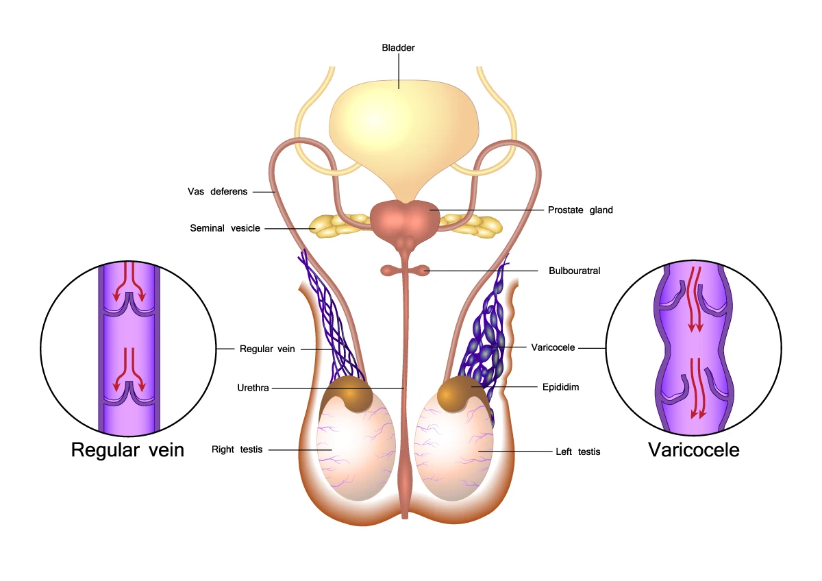 Varicocele illustration