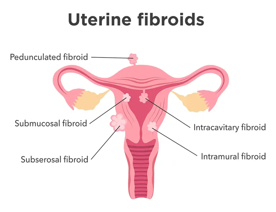 Image shows an anatomical breakdown of the different types of uterine fibroids.
