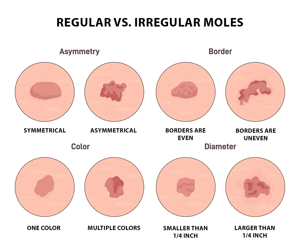 Image shows the difference between common and irregular moles, including differences in asymmetry, border, color and diameter.