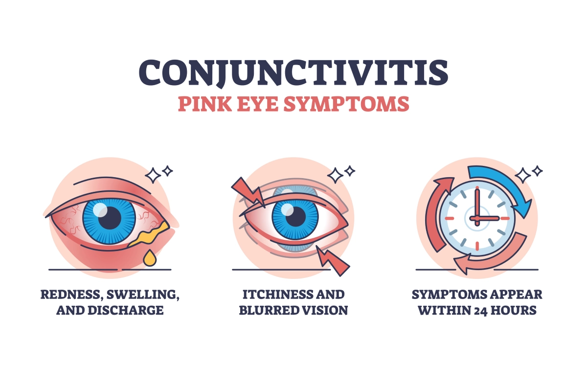 Illustration of pink eye symptoms showing redness, swelling, discharge, itchiness and blurred vision.