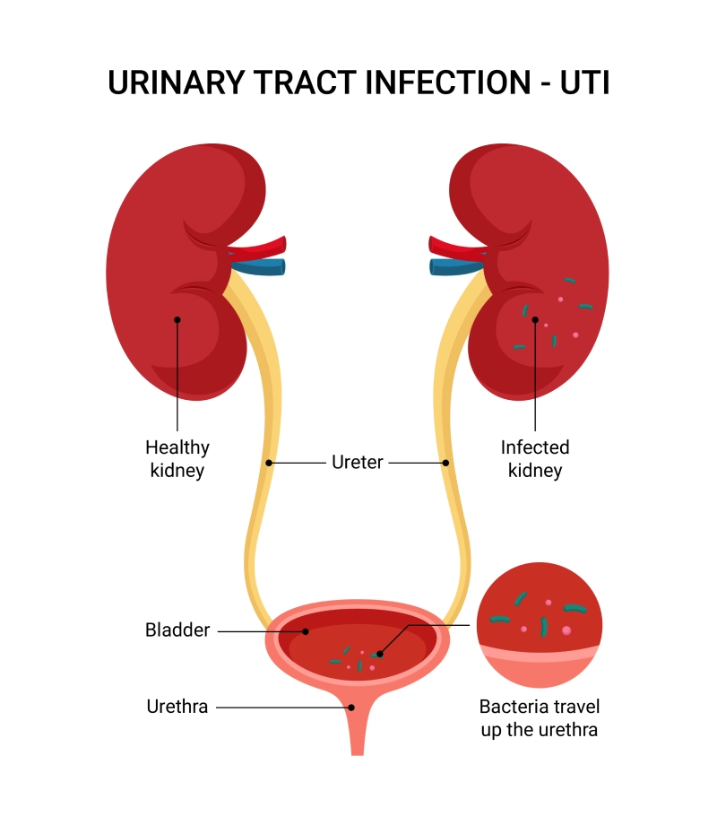 Urinary Tract Infection Urinary Tract Infection